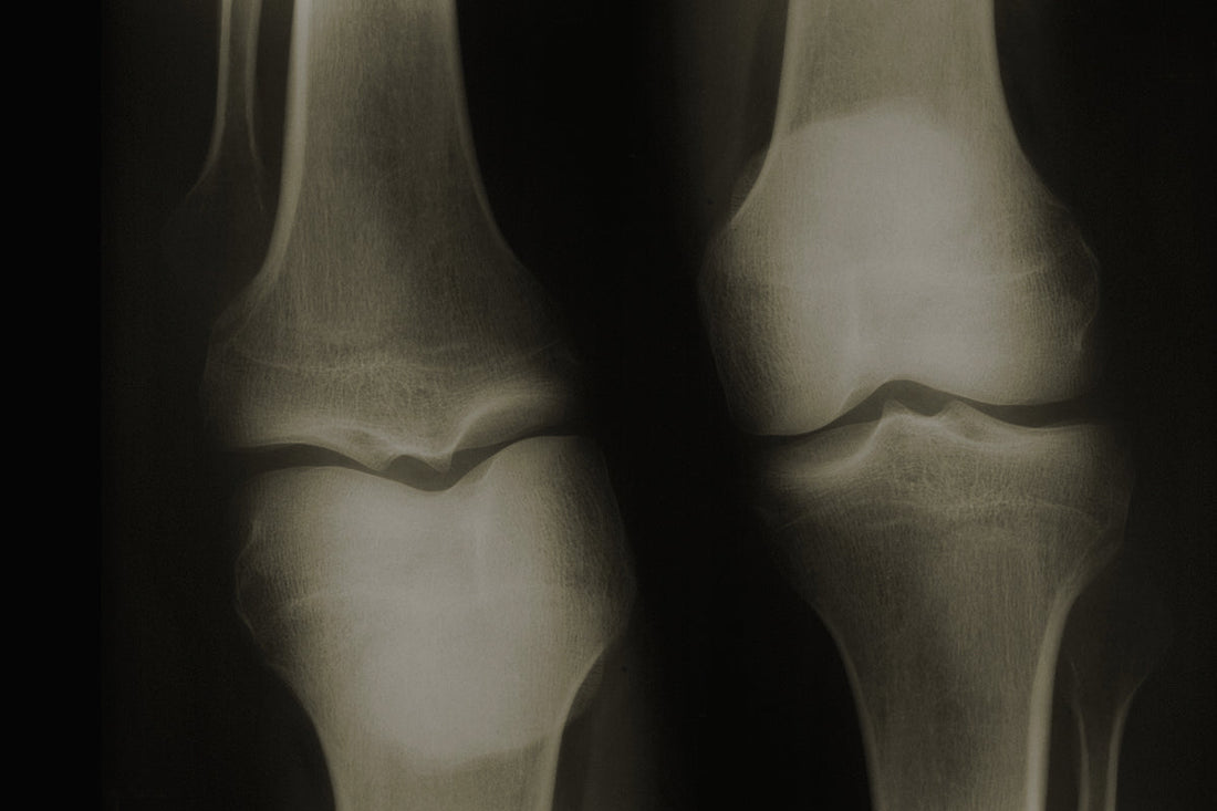 Antiinflamatorio natural para los huesos: una solución eficaz y segura para el dolor articular