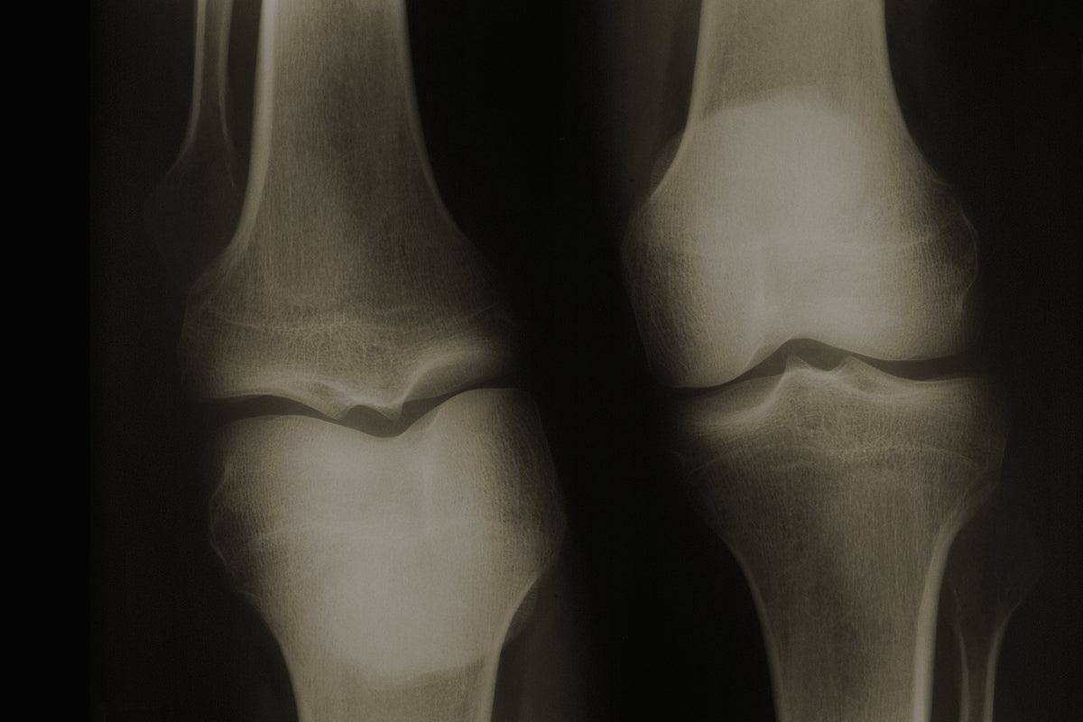 Antiinflamatorio natural para los huesos: una solución eficaz y segura para el dolor articular