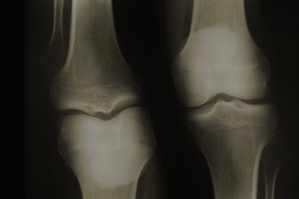 Antinfiammatorio naturale per le ossa: una soluzione efficace e sicura per il dolore articolare